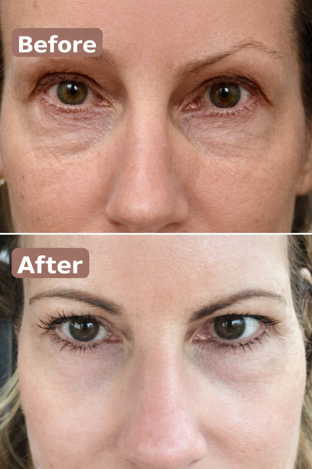 Glossiq™ Microneedle Eye Patches